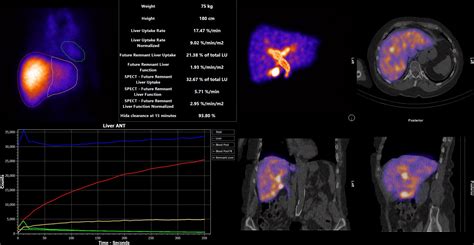 Liver remnant function 